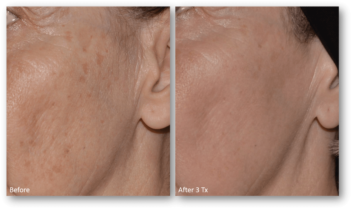 Before and After 4