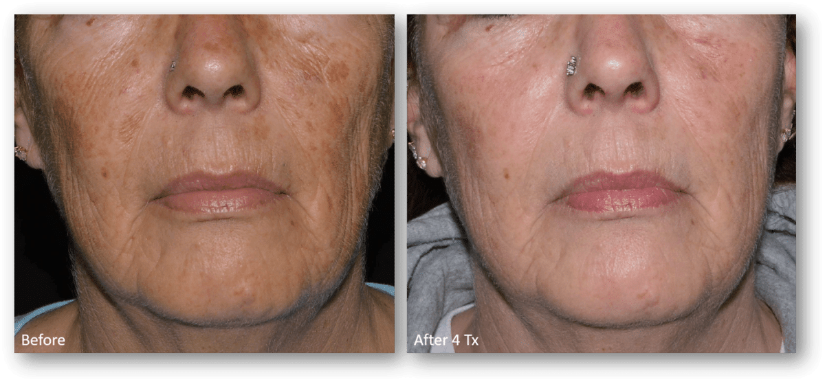 Before and After 5