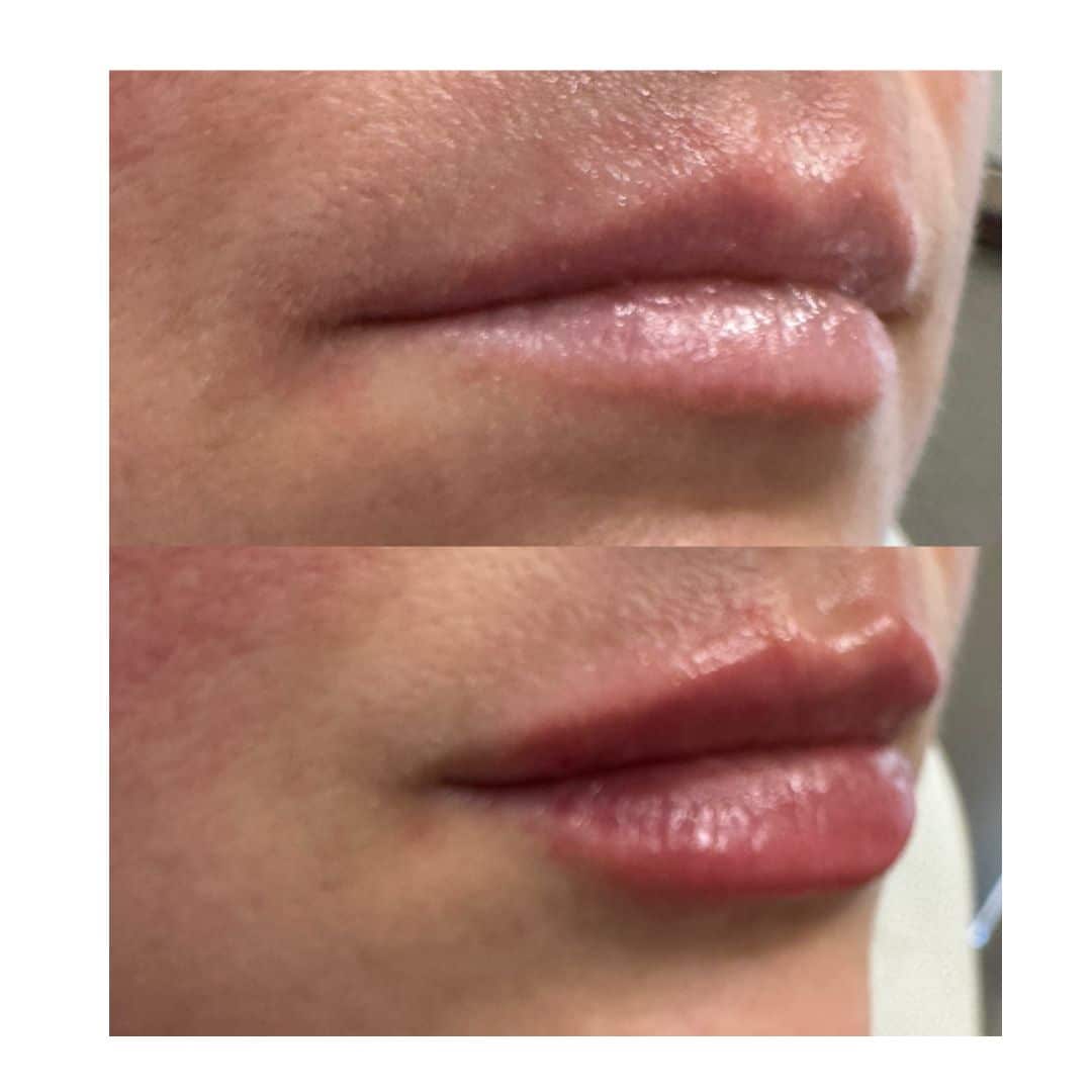 Before and After Image: Volbella Lips - right-front-oblique