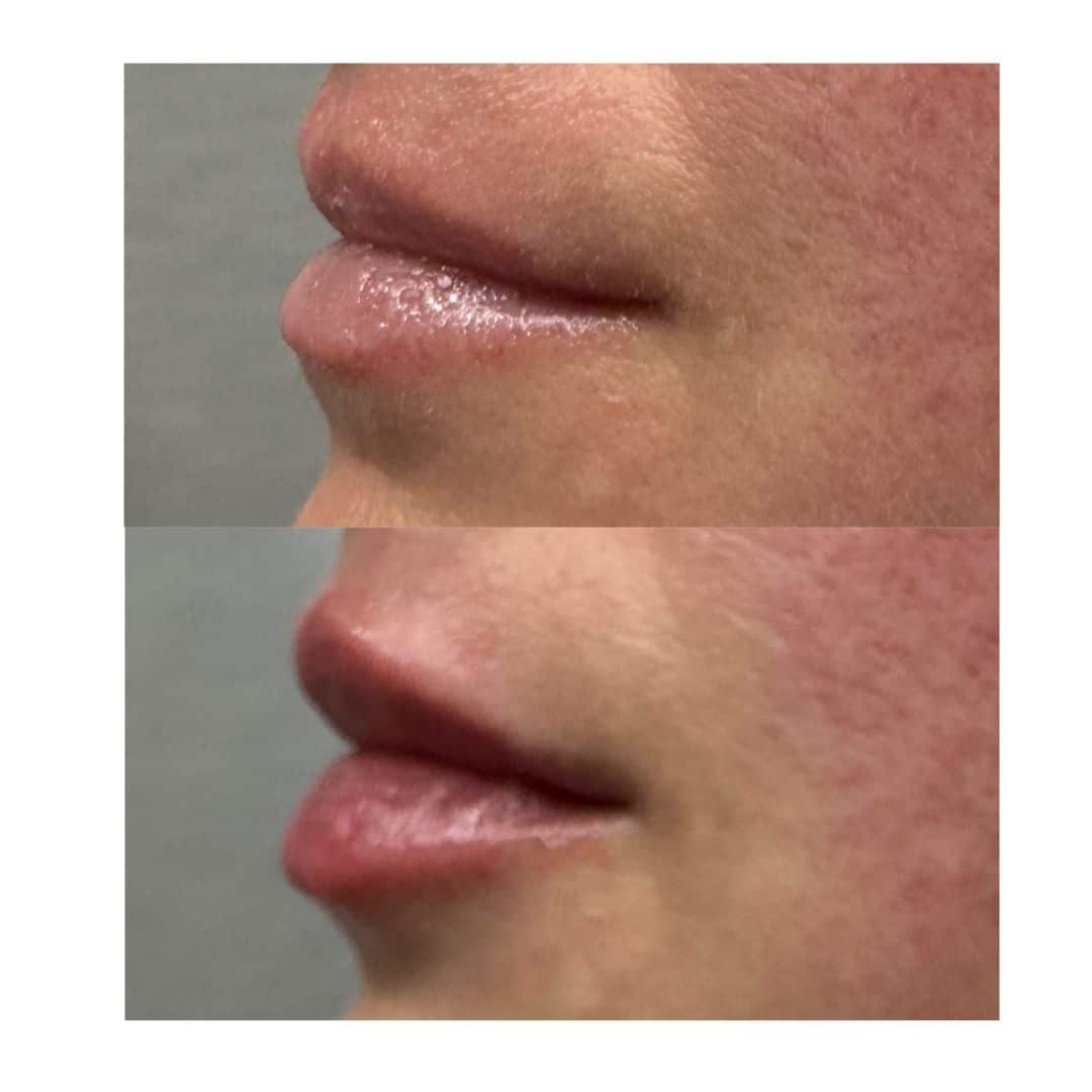 Before and After Image: Volbella Lips - left-side