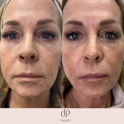 Before and After Image: LaseMD Ultra Face - front