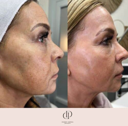 Before and After Image: LaseMD Ultra Face - right-side