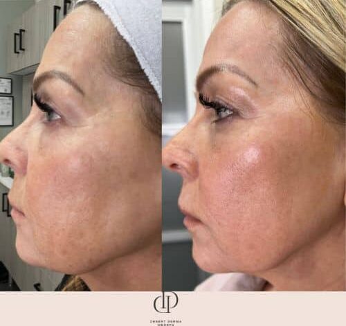 Before and After Image: LaseMD Ultra Face - left-side