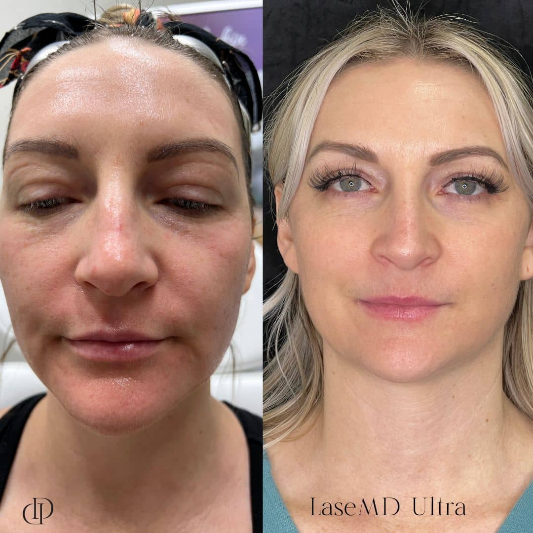 Before and After Image: LaseMD Ultra Face - front