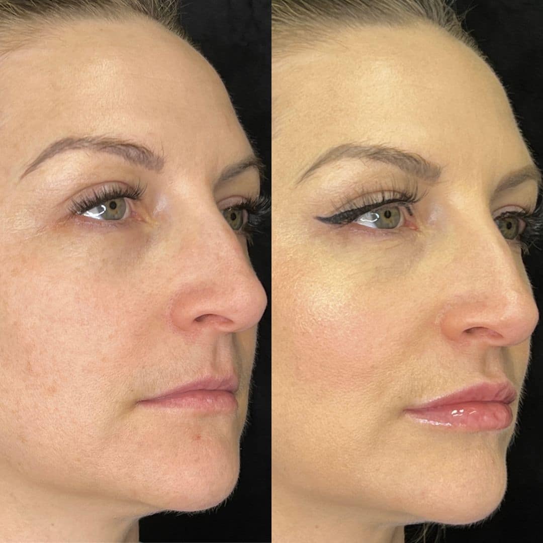 Before and After Image: LaseMD Ultra Face - right-front-oblique