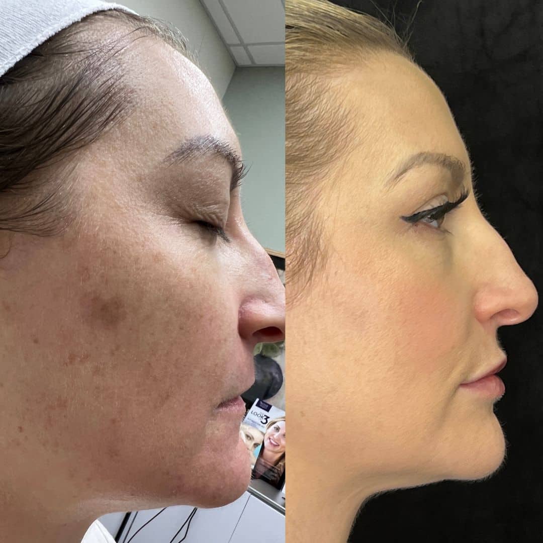 Before and After Image: LaseMD Ultra Face - right-side