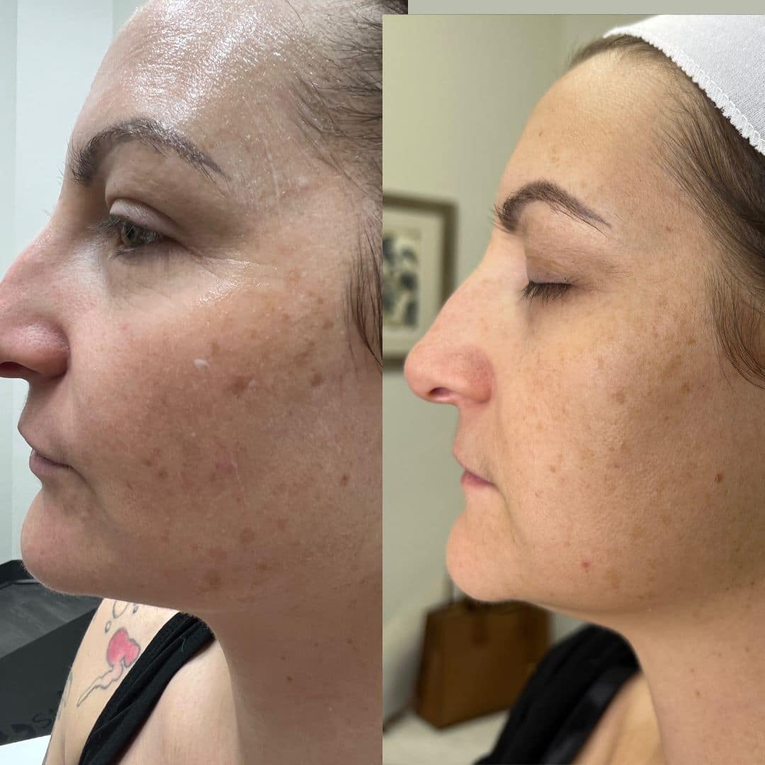 Before and After Image: LaseMD Ultra Face - left-side
