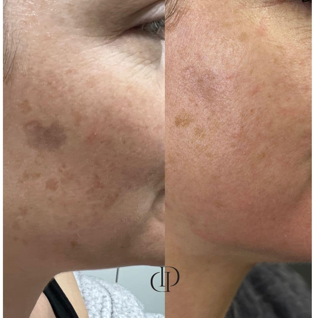 Before and After Image: LaseMD Ultra Face - right-side