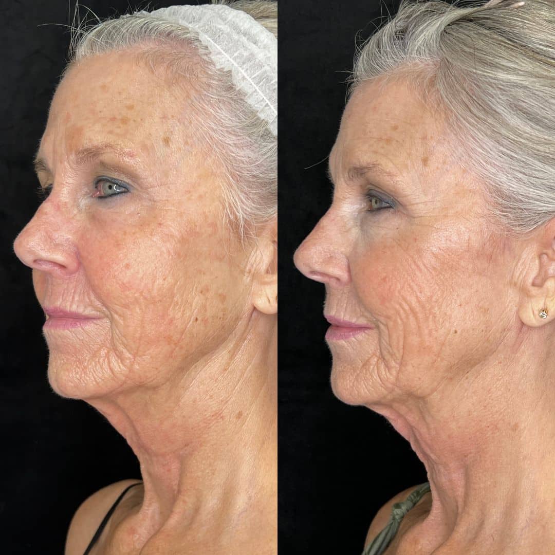 Before and After Image: LaseMD Ultra Face - left-front-oblique