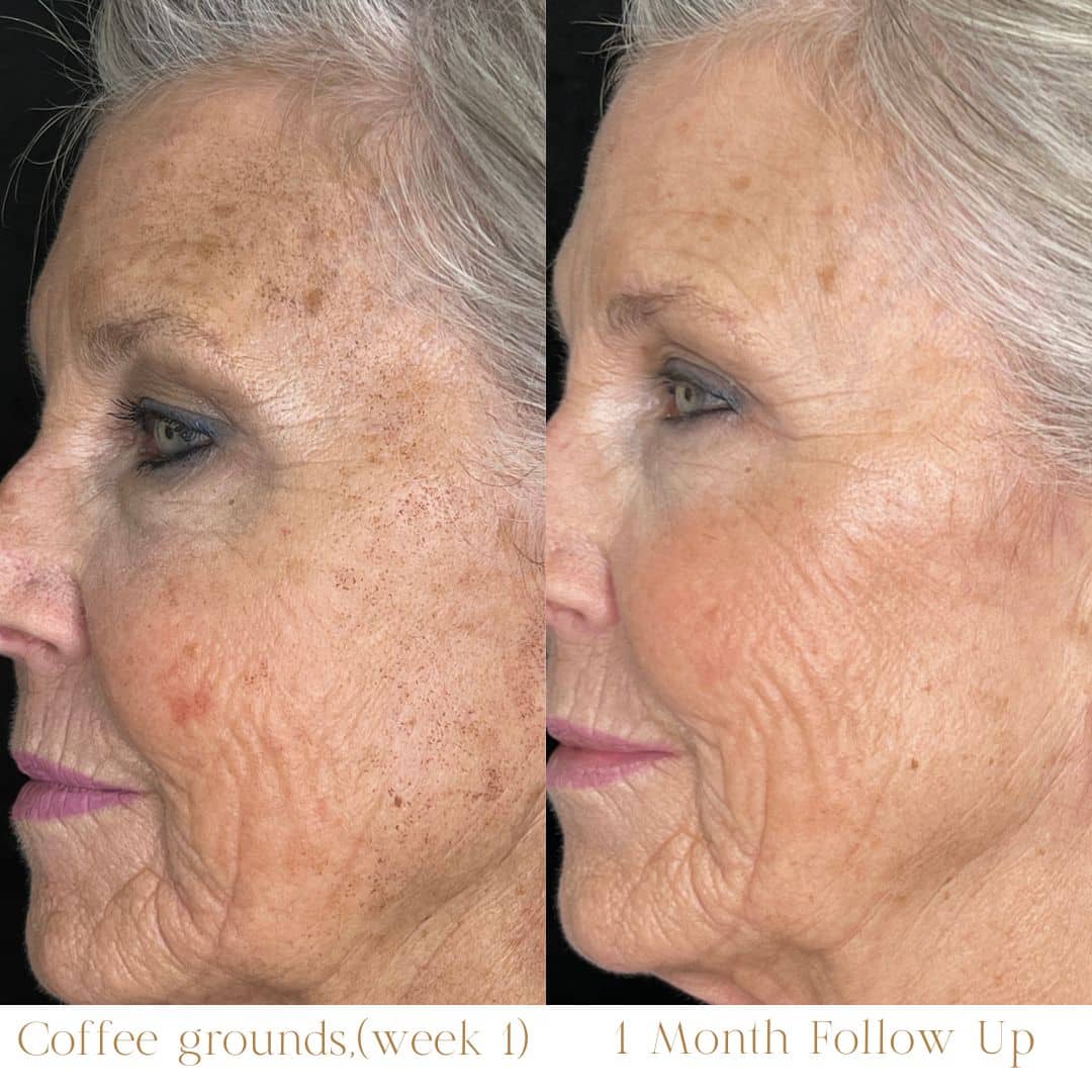 Before and After Image: LaseMD Ultra Face - left-side