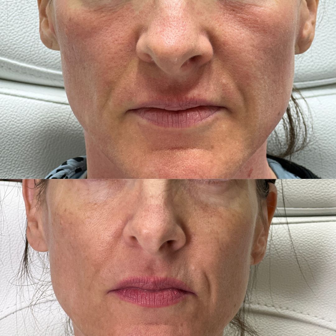 Before and After Image: LaseMD Ultra Face - front
