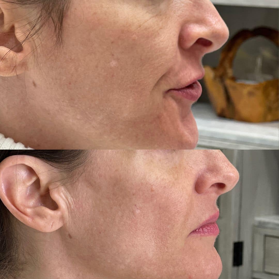 Before and After Image: LaseMD Ultra Face - right-side