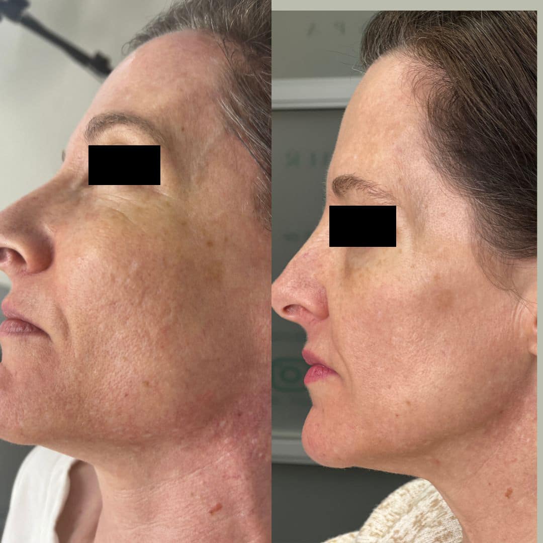 Before and After Image: LaseMD Ultra Face - left-side