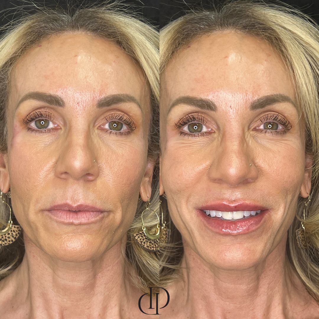 Before and After Image: Lip Filler - front