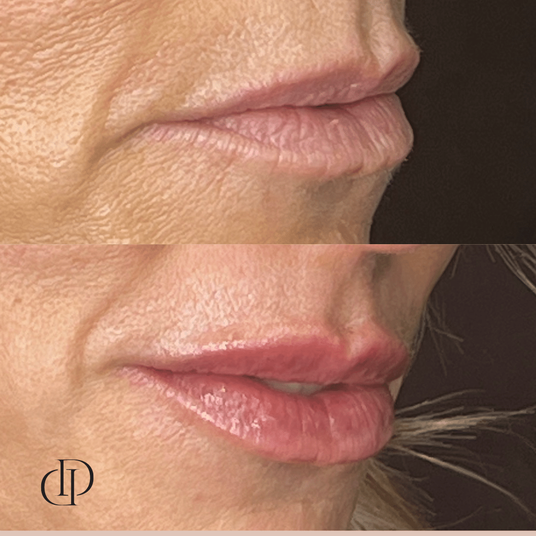 Before and After Image: Lip Filler - right-front-oblique