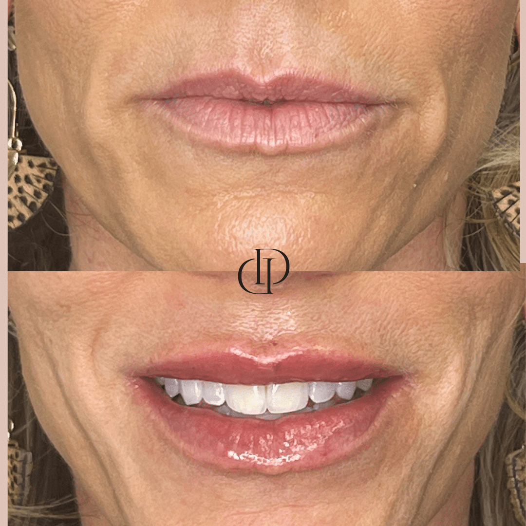 Before and After Image: Lip Filler - front