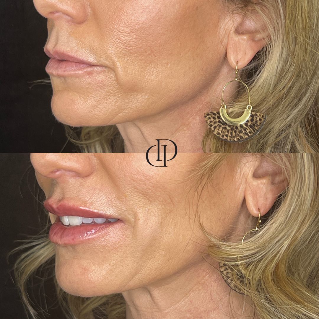 Before and After Image: Lip Filler - left-front-oblique