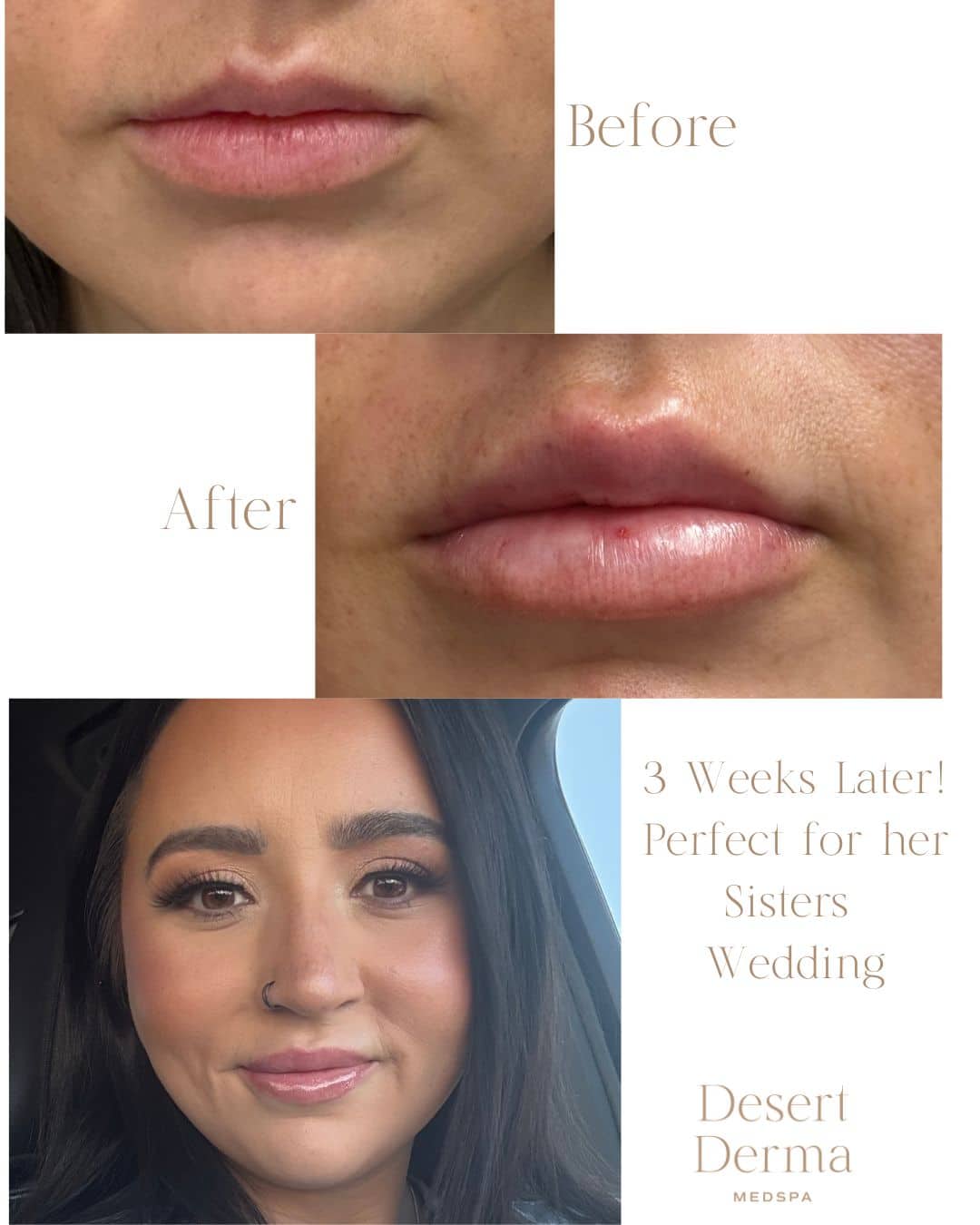 Before and After Image: Lip Filler - front