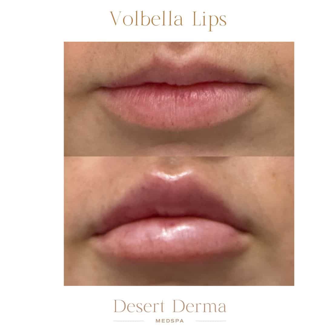 Before and After Image: Lip Filler - front