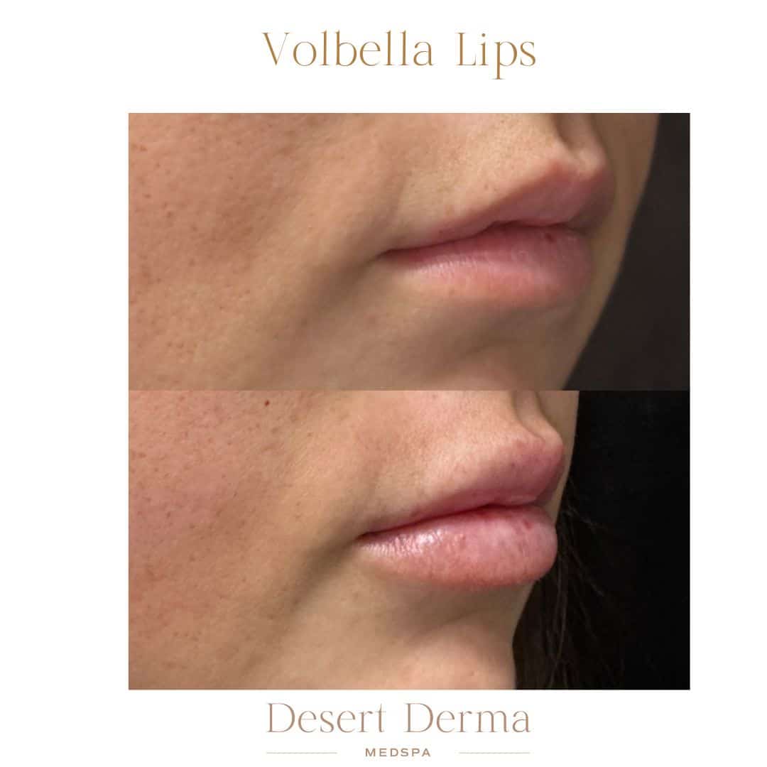 Before and After Image: Lip Filler - right-front-oblique