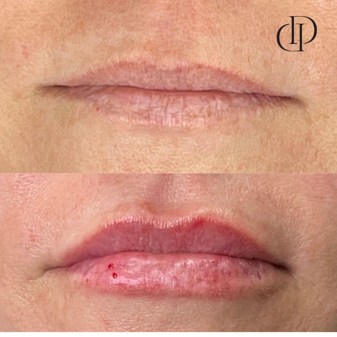 Before and After Image: Lip Filler -