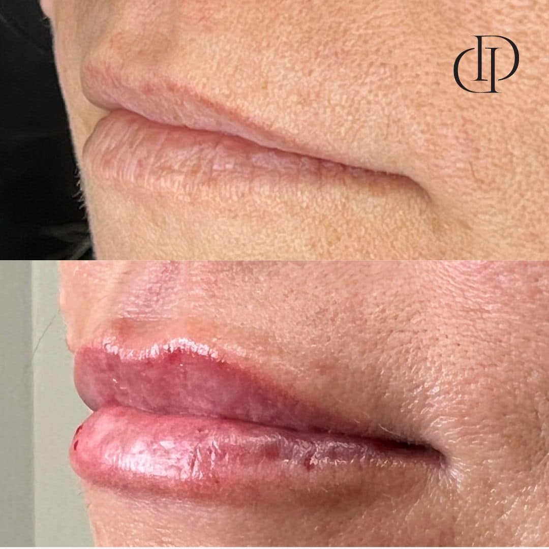 Before and After Image: Lip Filler - left-front-oblique