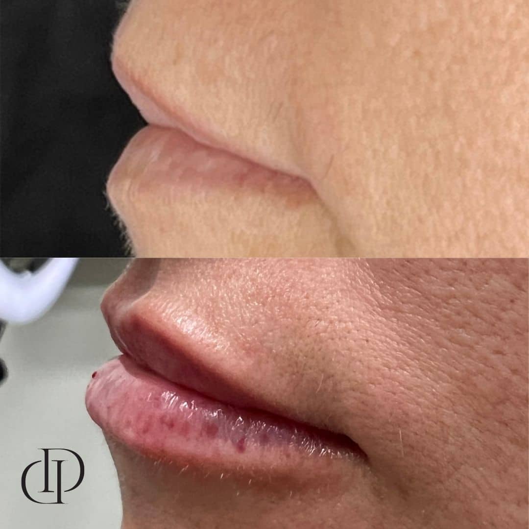 Before and After Image: Lip Filler -