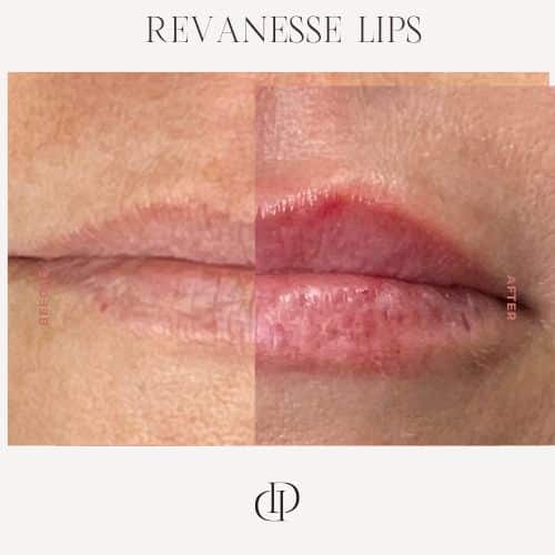 Before and After Image: Lip Filler - front