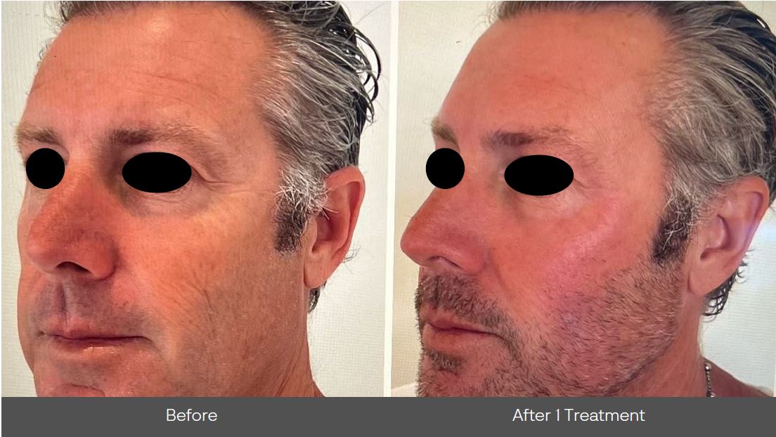 Before and After Image: Mosaic 3D - left-front-oblique