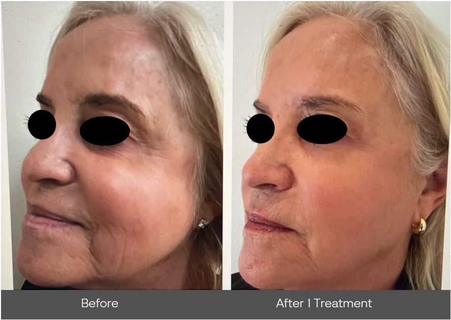 Before and After Image: Mosaic 3D - left-front-oblique