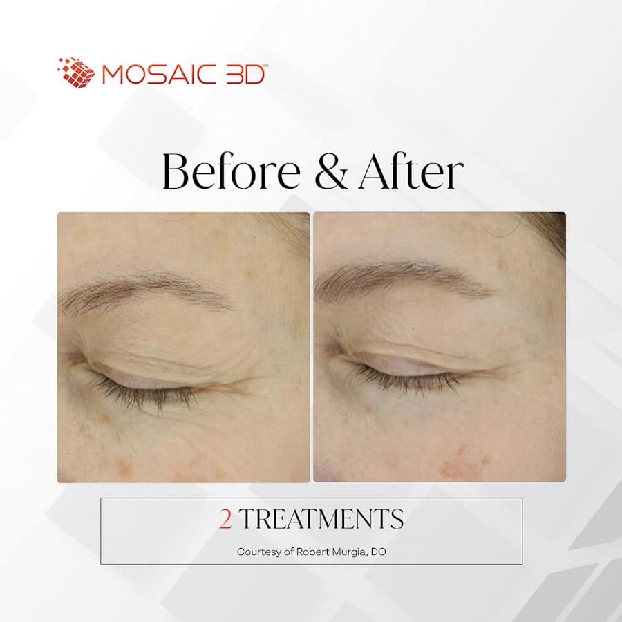 Before and After Image: Mosaic 3D - left-front-oblique