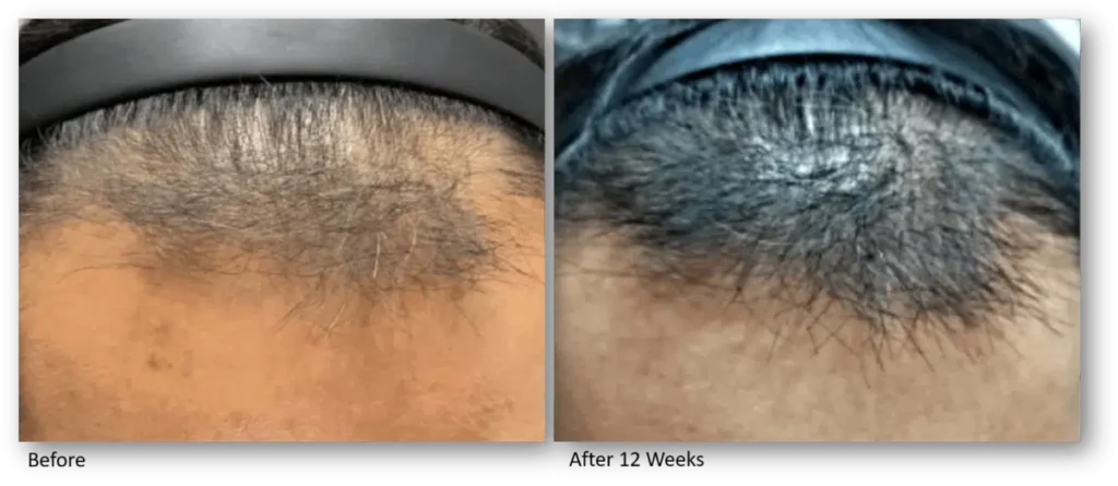 LaseMD Ultra in Peoria & Glendale AZ