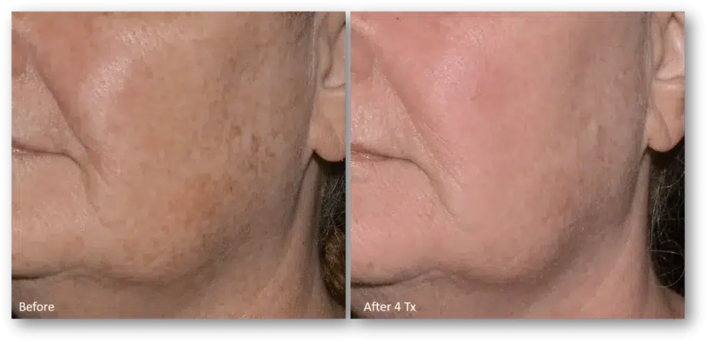 LaseMD Ultra in Peoria & Glendale AZ