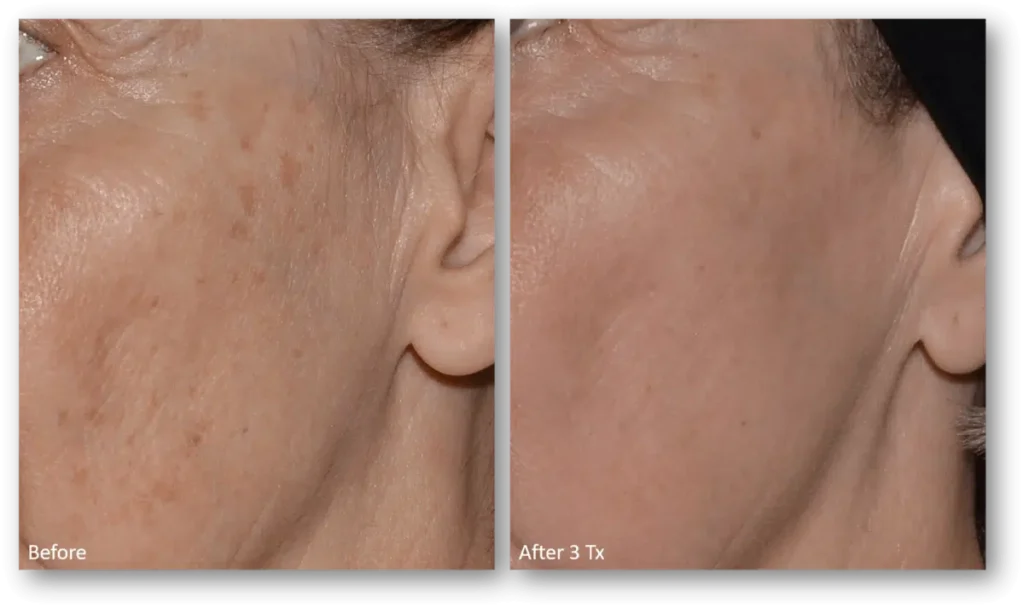 LaseMD Ultra in Peoria & Glendale AZ