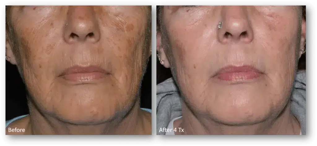 LaseMD Ultra in Peoria & Glendale AZ